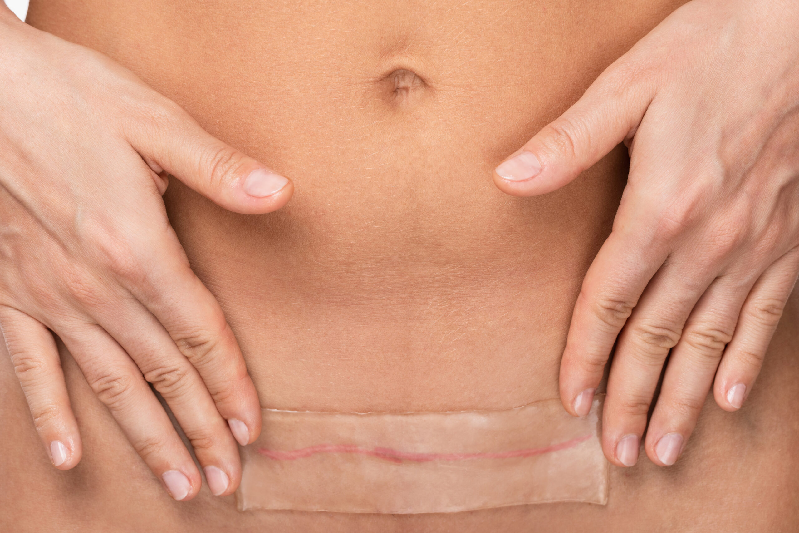 Application d'un pansement silicone sur cicatrice abdominale — traitement post-opératoire, Dr Alexandra Tudosa Saint-Omer