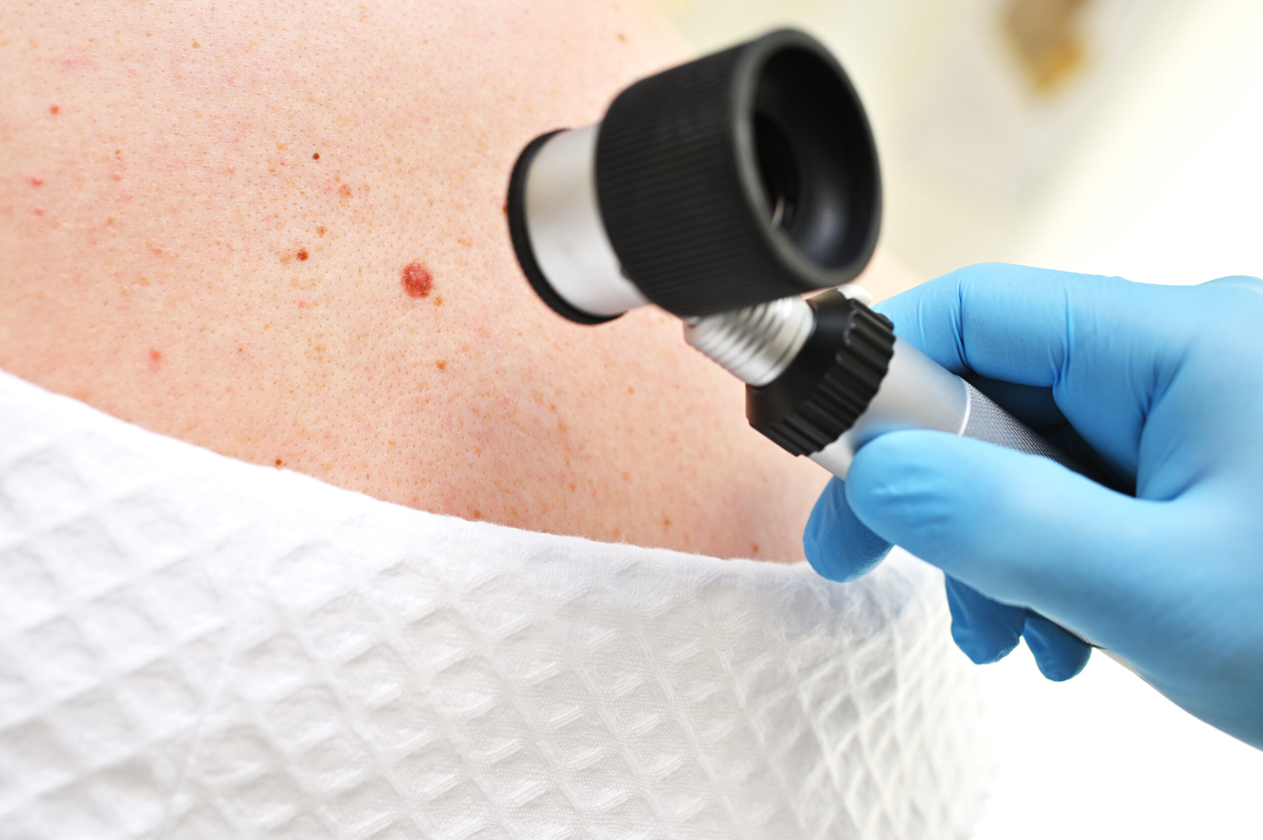 Chirurgie des tumeurs cutanées — examen dermatoscopique, Dr Alexandra Tudosa chirurgien plasticien Saint-Omer